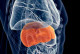 Advierten desarrollo de cáncer hepático por hepatitis mal cuidada 
